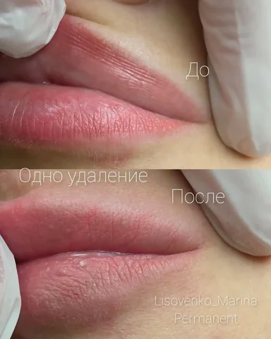 Удаление татуажа губ и век на 22 апреля - Маркетинг/Продажи в Сургут