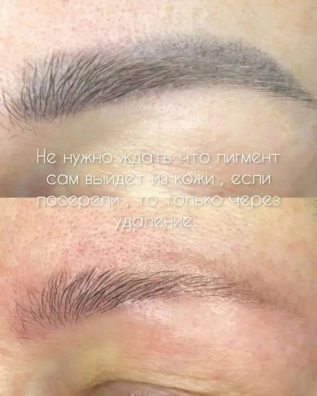 Удаление татуажа бровей в Сургуте - Косметологические услуги (Услуги) в Сургут