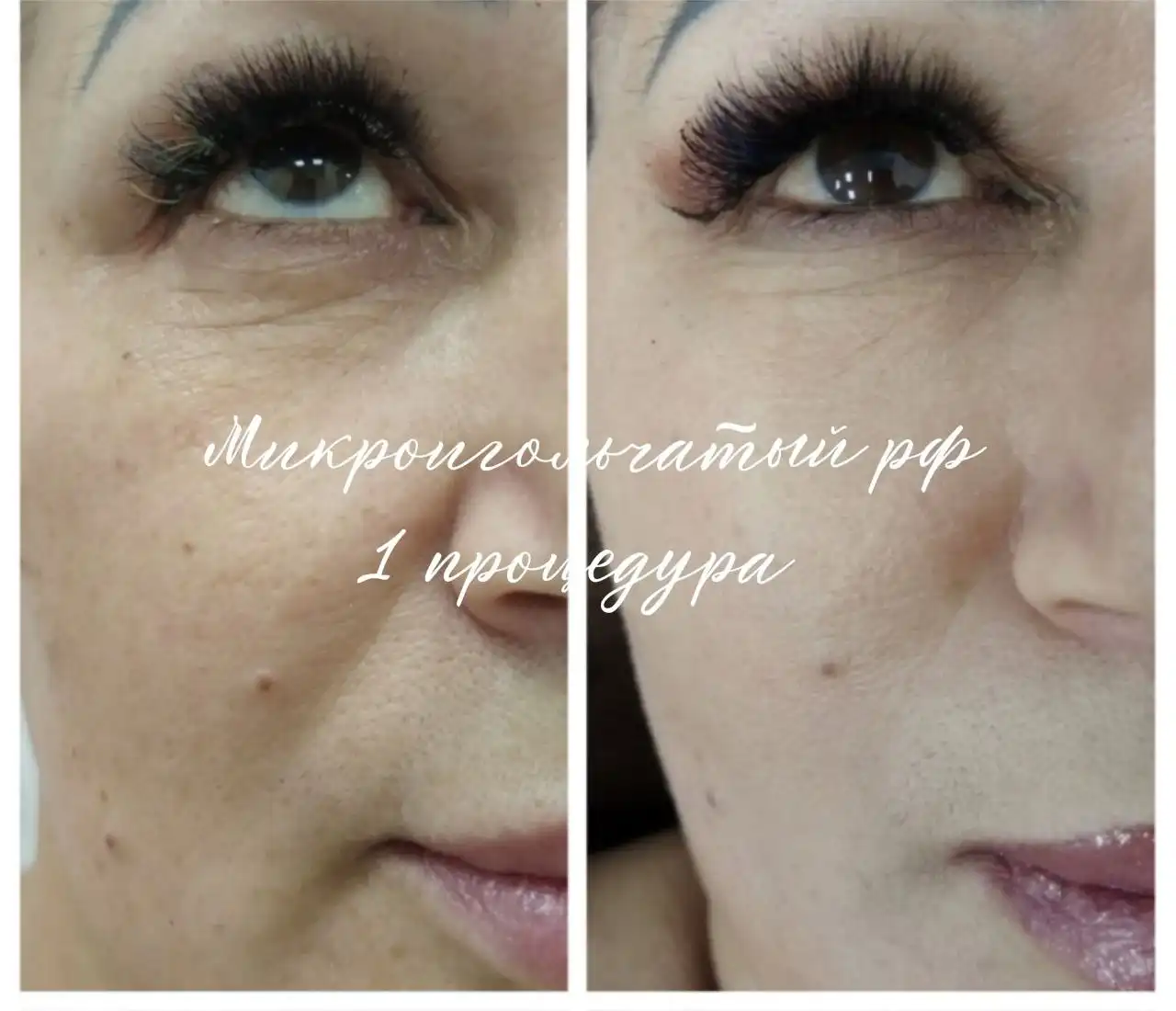 Микроигольчатый РФ лифтинг в Самаре