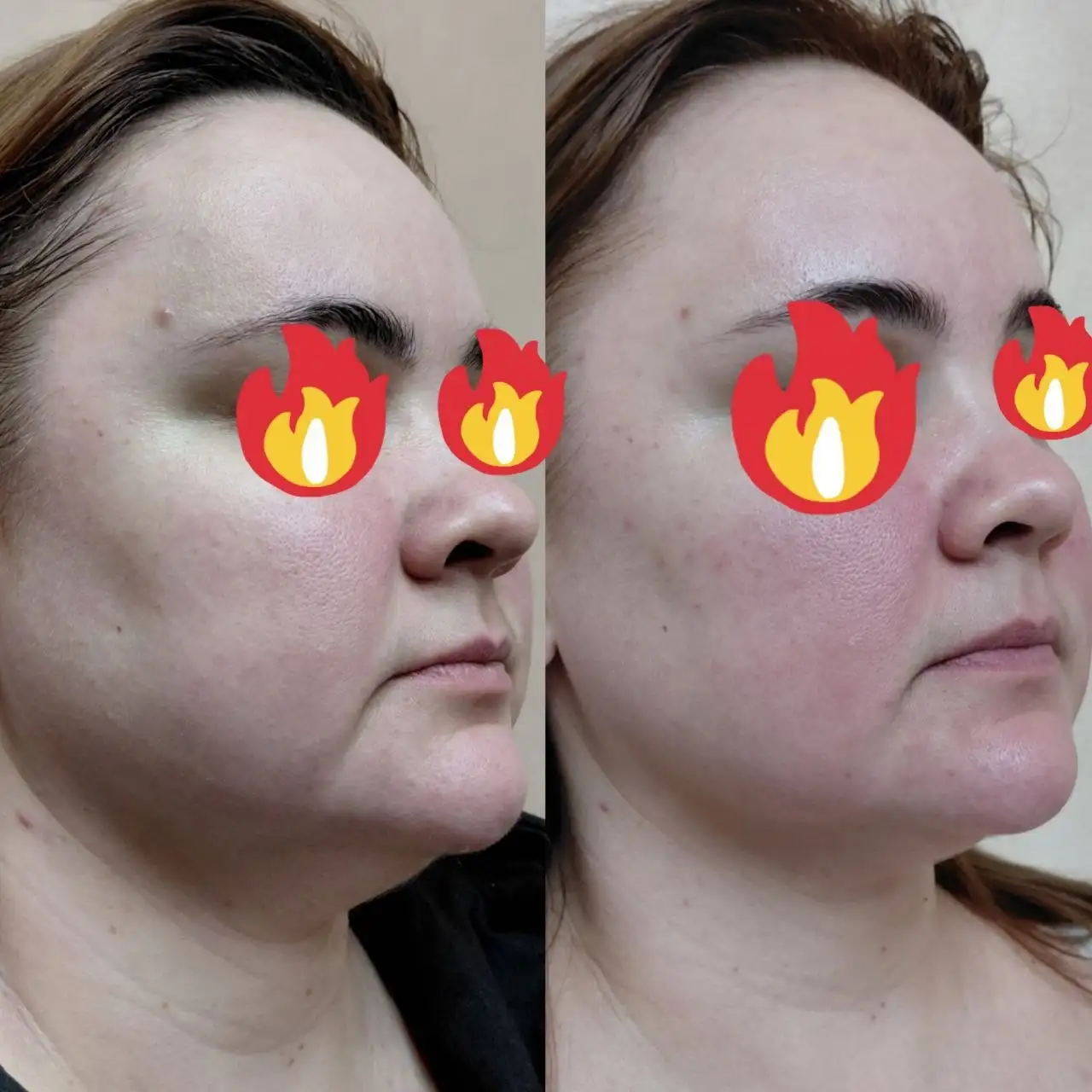 Французский скульптурный массаж лица - Косметологические услуги (Красота и здоровье) в Самара