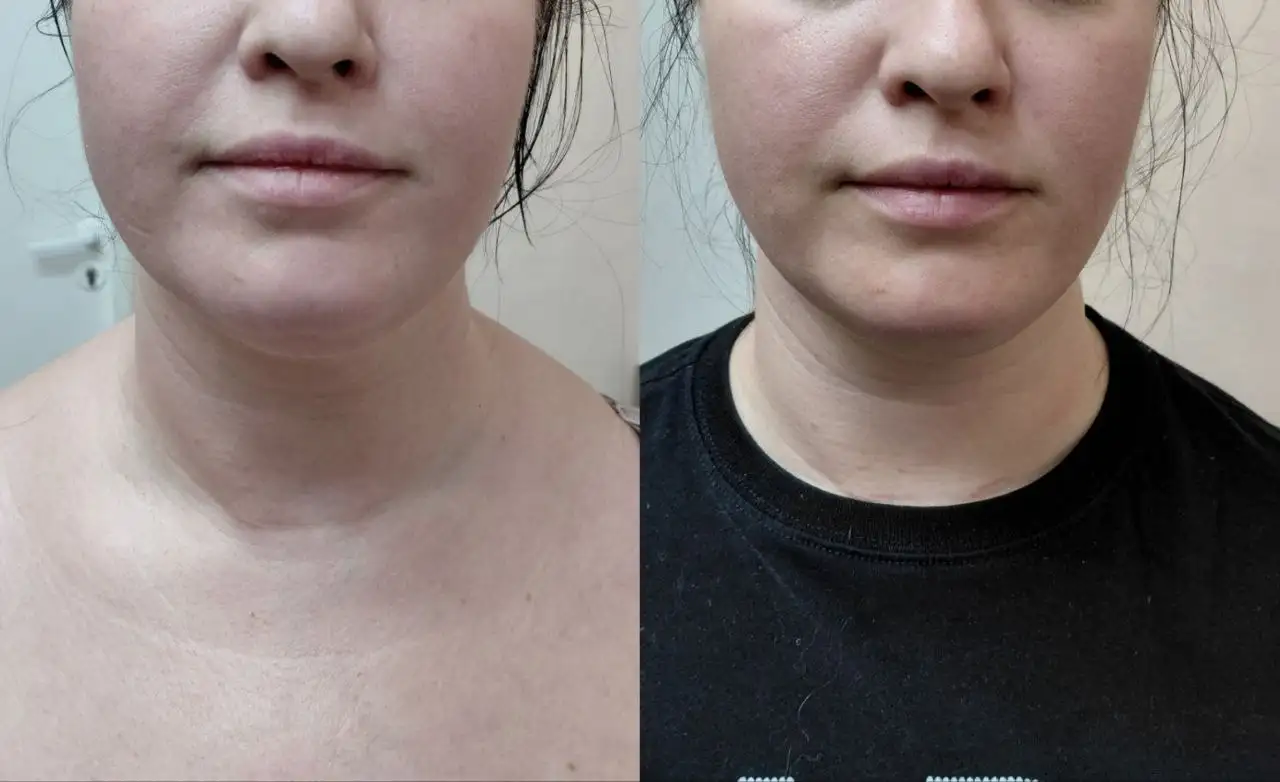 Французский скульптурный массаж лица - Косметологические услуги (Красота и здоровье) в Самара