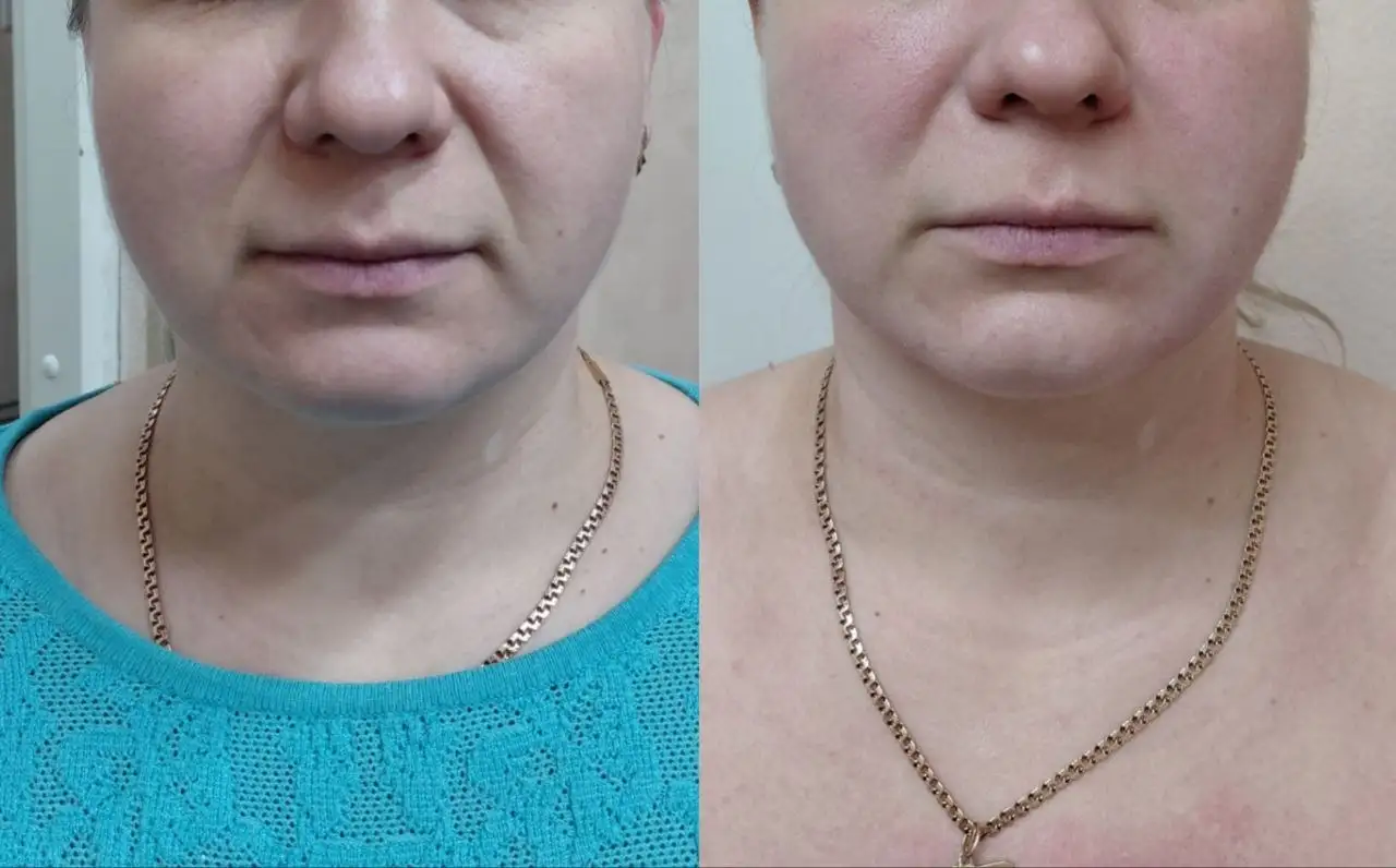 Французский скульптурный массаж лица - Косметологические услуги (Красота и здоровье) в Самара