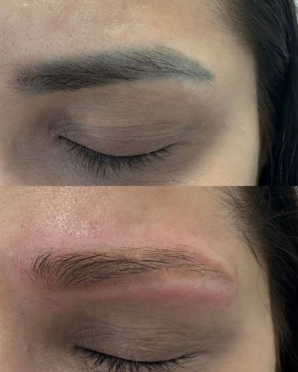 Удаление татуажа лазером в Тюмени - Косметология (Услуги) в Тюмень