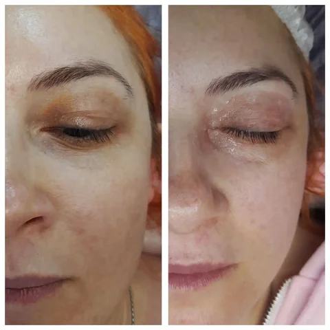 Перманентный камуфляж темных кругов вокруг глаз - частное объявление в Тюмень