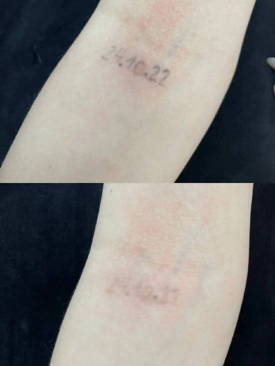 Удаление тату лазером в Тюмени - Красота и здоровье (Услуги) в Тюмень