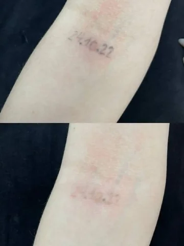 Удаление тату лазером в Тюмени - Обучение и курсы в Тюмень