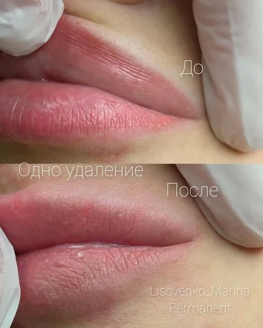 Удаление татуажа губ и век в Сургуте - Маркетинг/Продажи в Сургут
