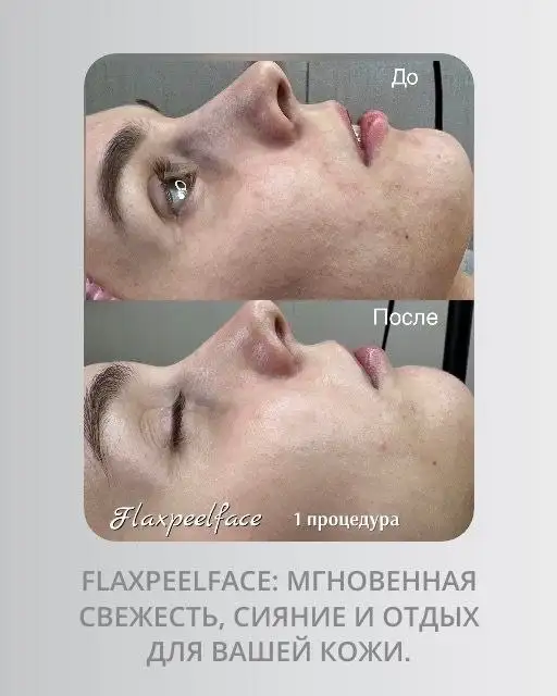 Атравматическая чистка лица FlaxPeelFace - Уход за лицом (Красота и здоровье) в Оренбург