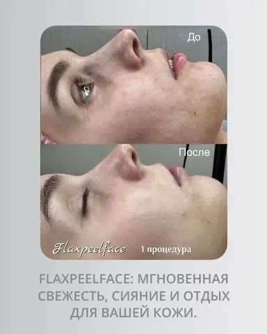Атравматическая чистка лица FlaxPeelFace - Салоны красоты в Оренбург