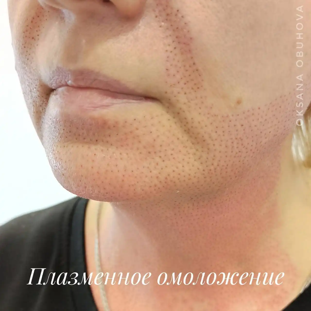 Плазма лифтинг: принципы работы и процедура - Косметологические услуги (Красота и здоровье) в Оренбург