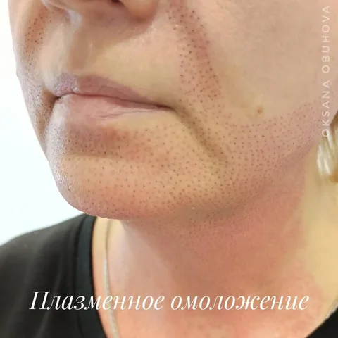 Плазма лифтинг: принципы работы и процедура - Товары для здоровья в Оренбург