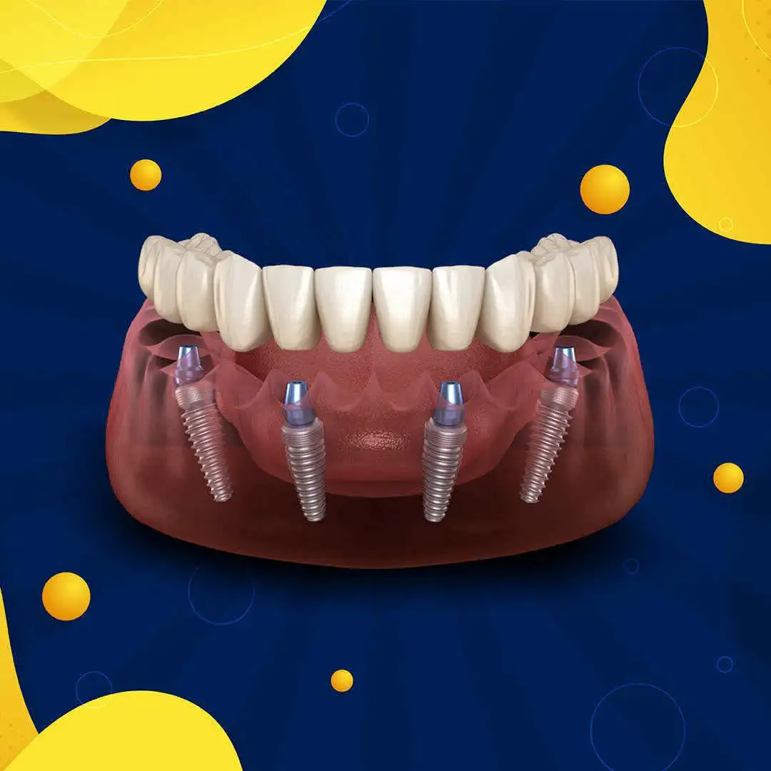 Восстановление челюсти по швейцарскому методу - Медицинские (Услуги) в Тольятти