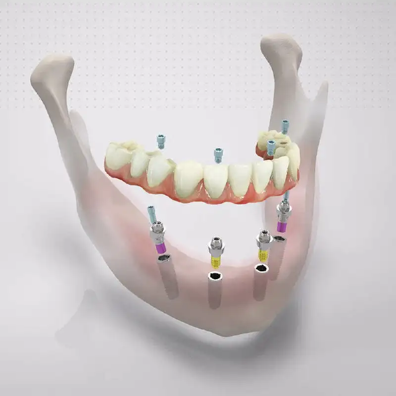 Восстановление челюсти по швейцарскому методу - Медицинские (Услуги) в Тольятти