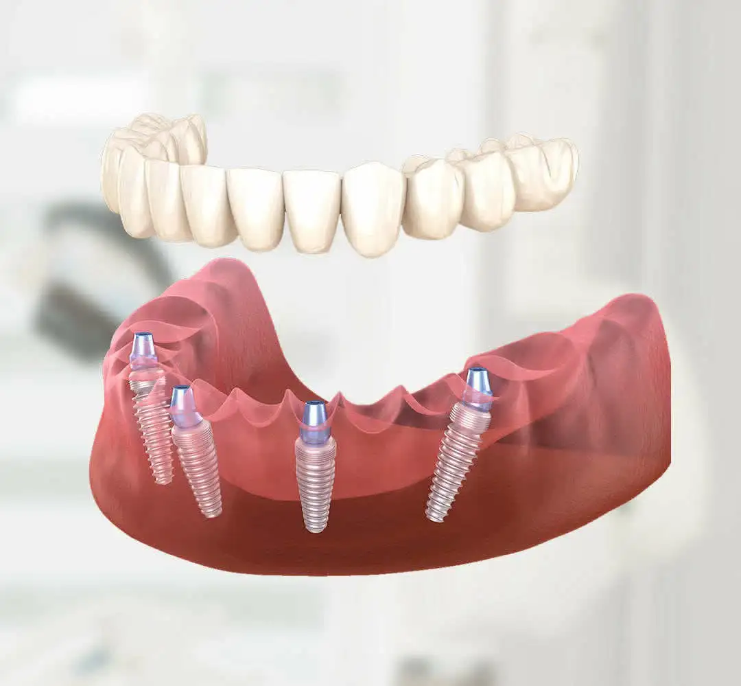 Восстановление челюсти по швейцарскому методу - Медицинские (Услуги) в Тольятти