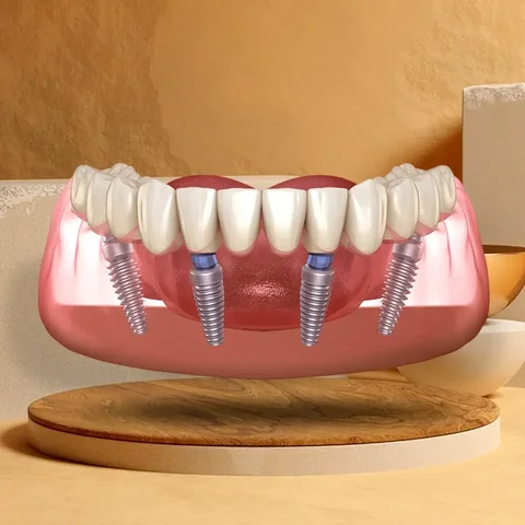 Установка новых зубов на 4 имплантах за 1 день в Самаре - Стоматология в Самара