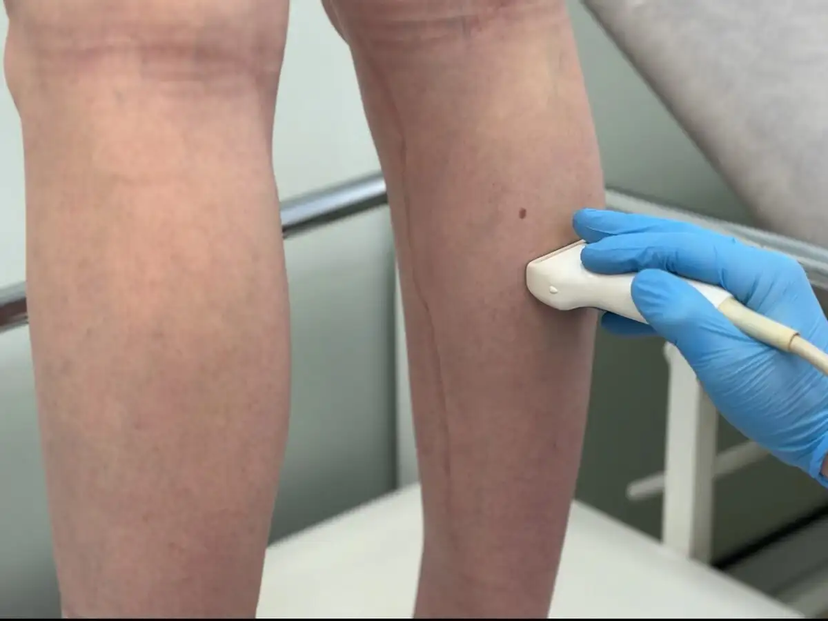 Консультация и УЗИ ног в клинике флебологии Самары - Медицинские услуги (Услуги) в Самара