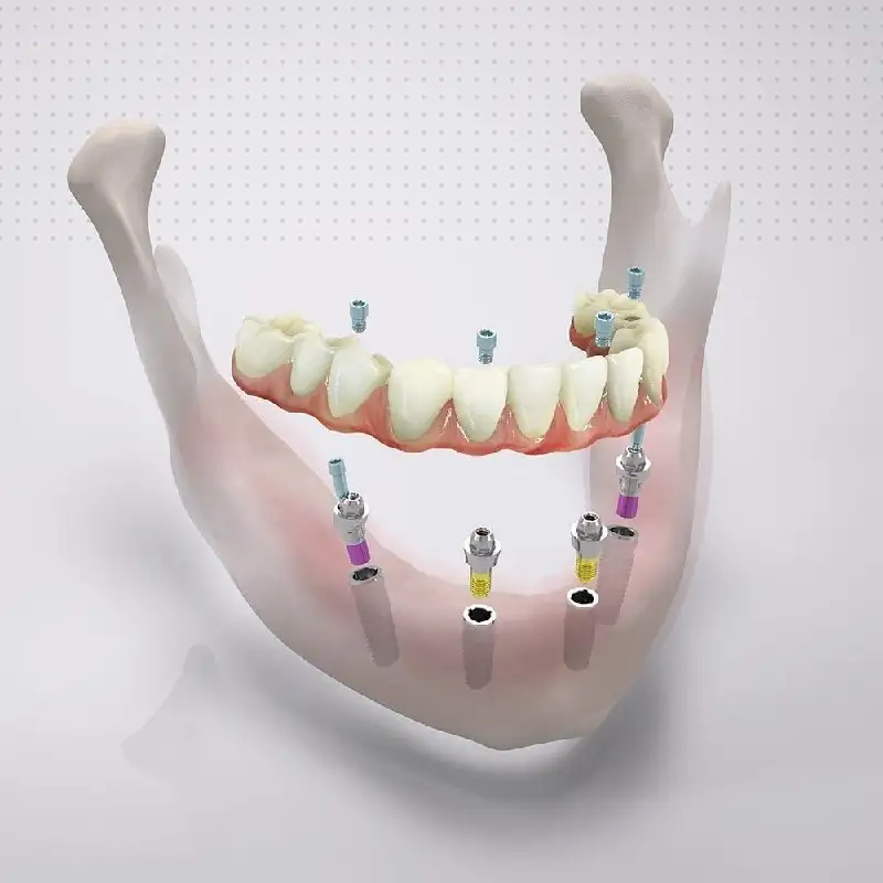 Имплантация «Все зубы сразу» в Самаре - Медицинские услуги (Услуги) в Самара