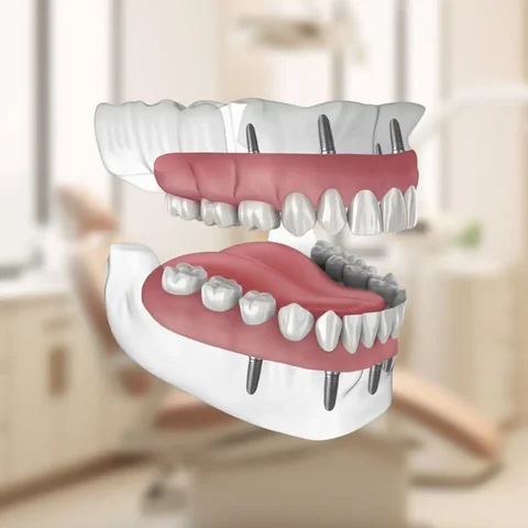 Восстановление зубов с лечением во сне в стоматологии Ладья - Массаж и СПА в Самара