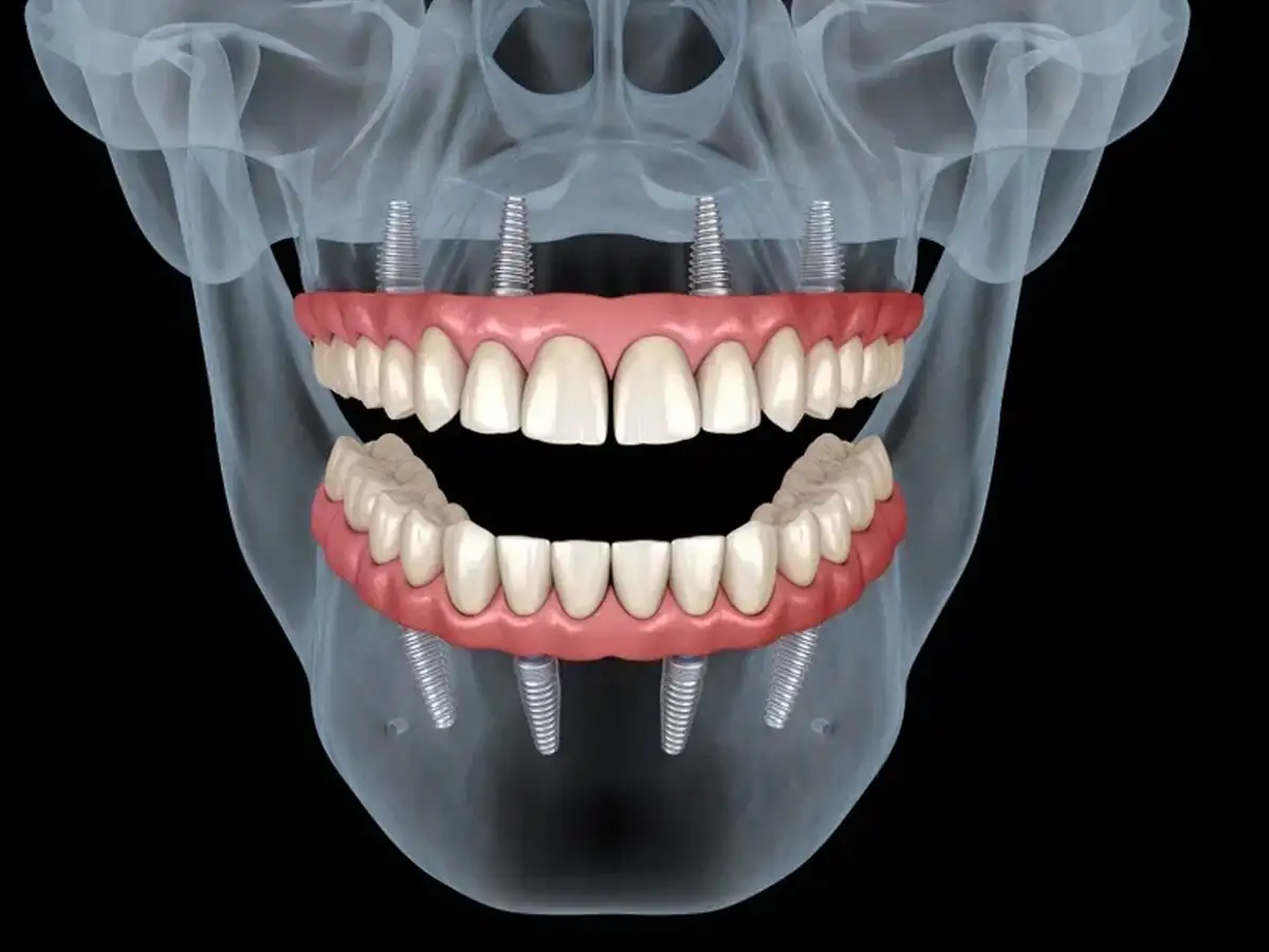Восстановление челюсти за 1 день в Самаре - Медицинские услуги (Услуги) в Самара