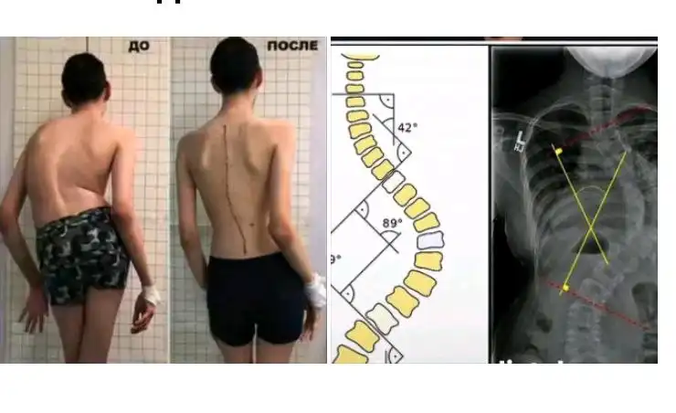 Услуги по коррекции осанки и сколиоза