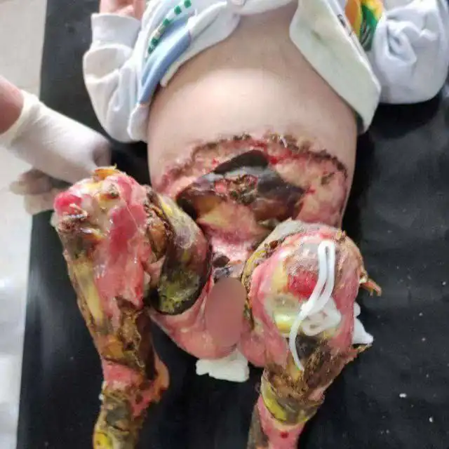 Помощь пострадавшей девочке в Омске - Благотворительность (Услуги) в Омск