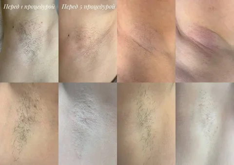 Электроэпиляция - удаление волос навсегда - Косметология в Донецк