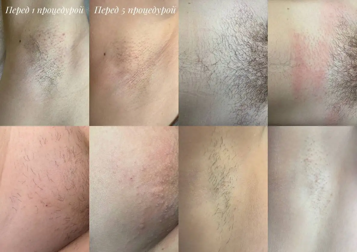 Электроэпиляция - удаление волос навсегда - Эпиляция (Красота и здоровье) в Донецк
