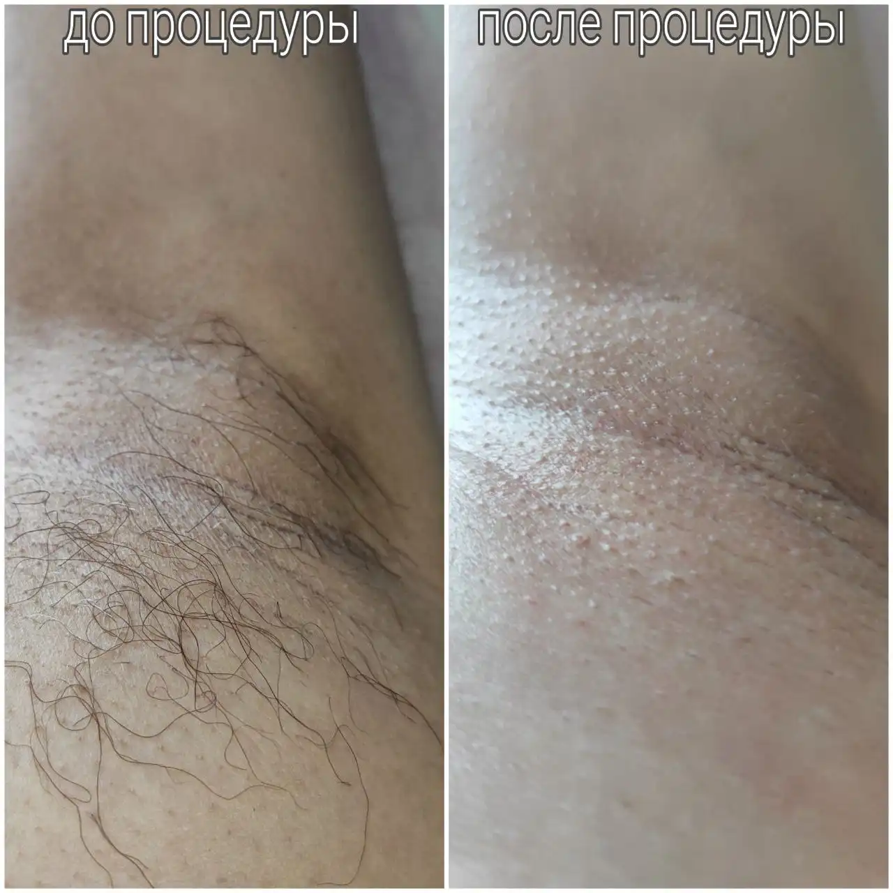 Услуги мастера восковой депиляции и шугаринга