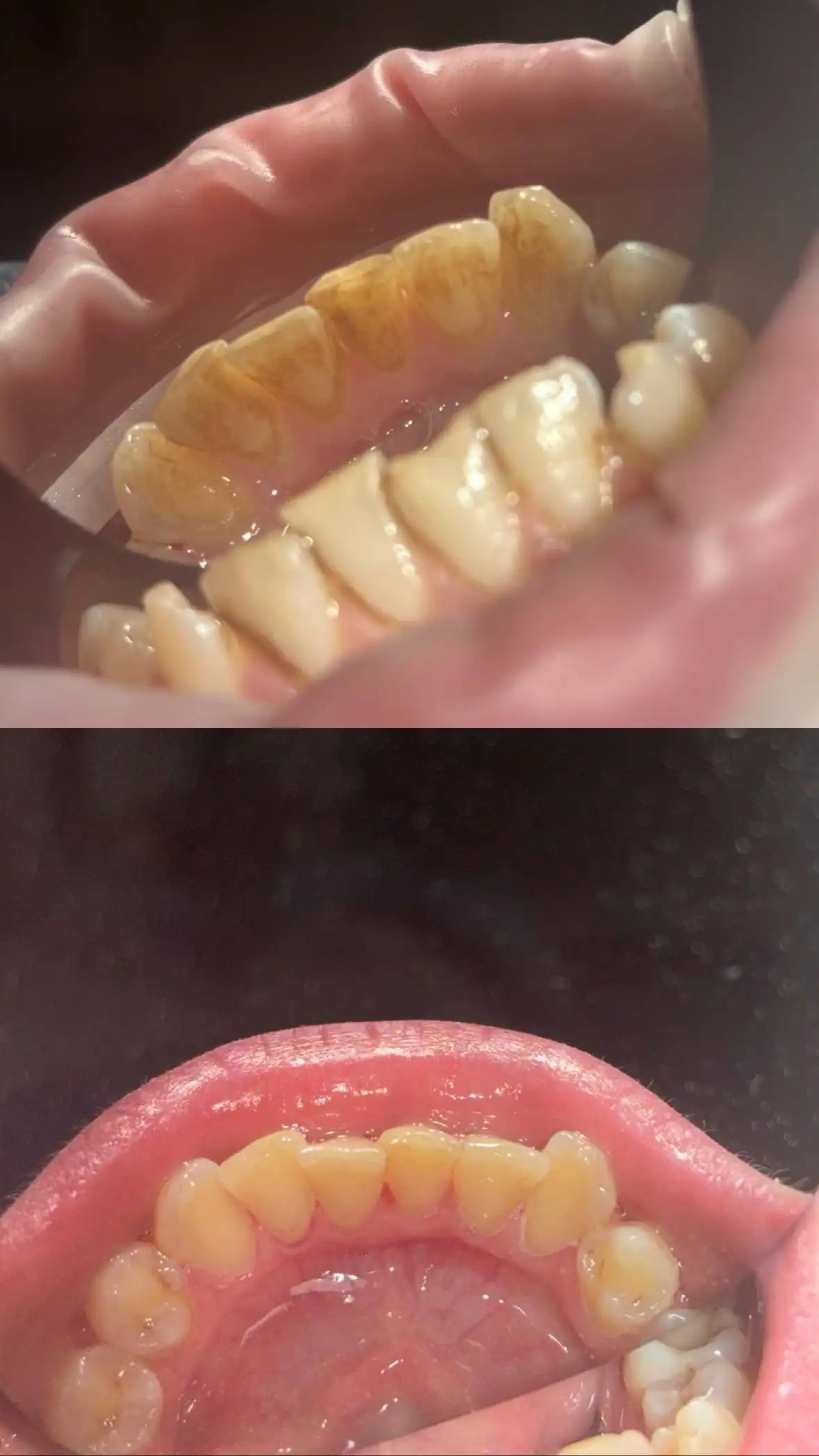 Профессиональная гигиена полости рта и лечение кариеса