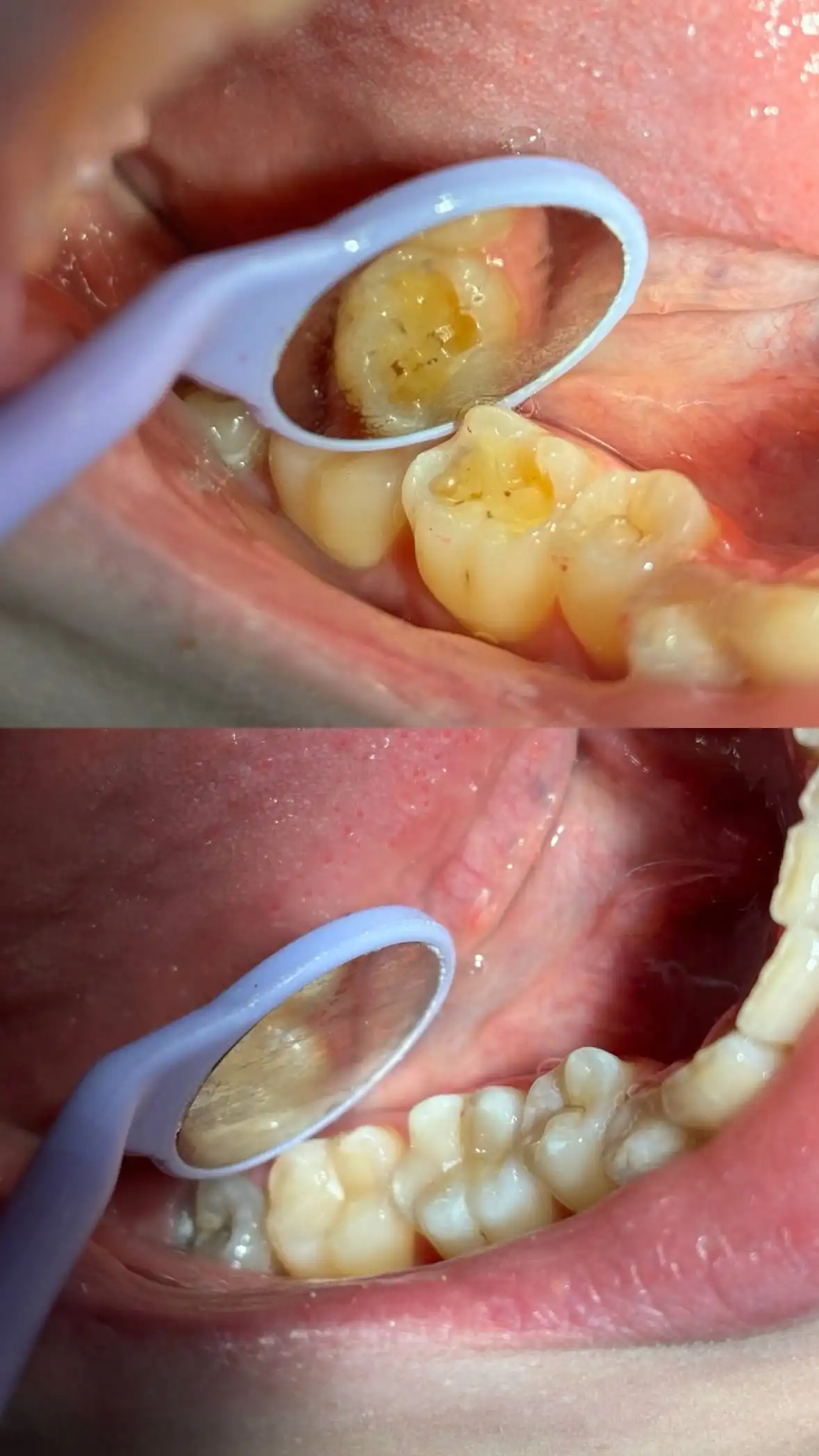 Профессиональная гигиена полости рта и лечение кариеса