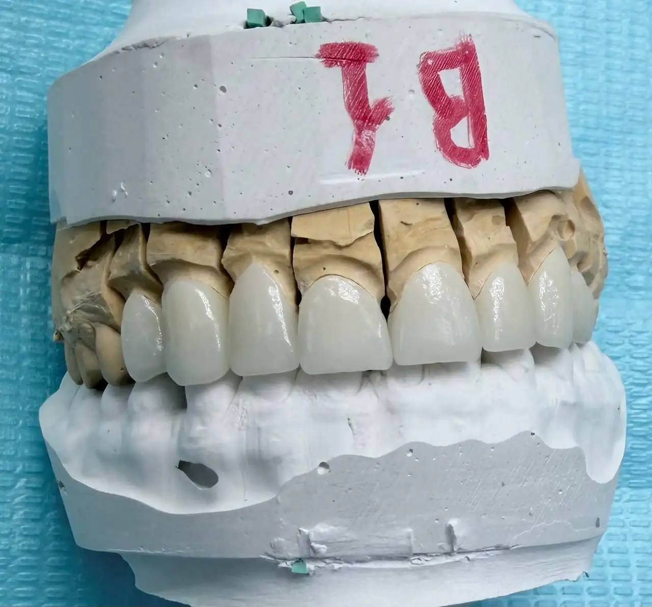 Циркониевые виниры и коронки оттенка BL1 в Тюмени - Стоматология (Красота и здоровье) в Тюмень