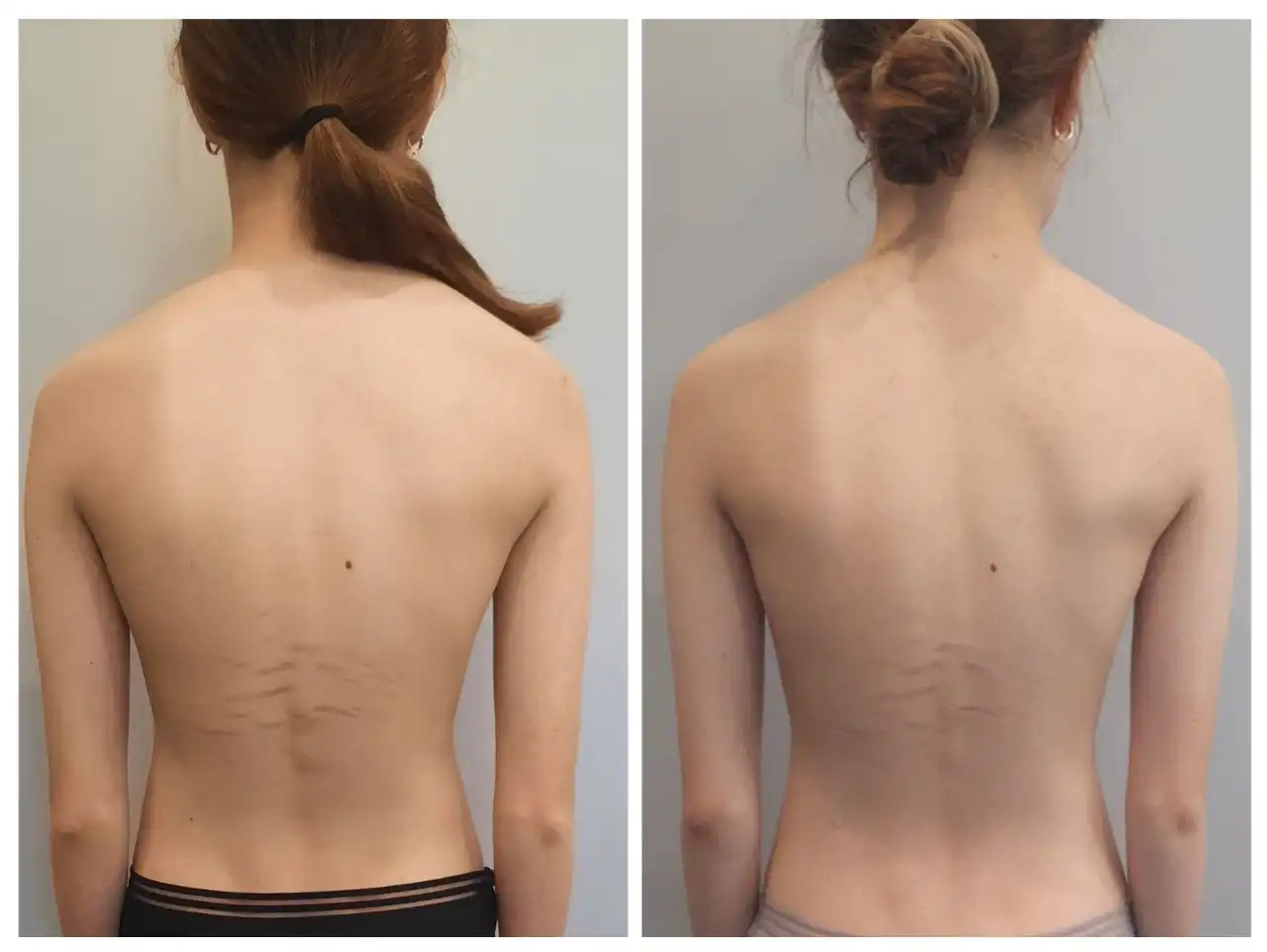 Услуги остеопата при сколиозе и сутулости