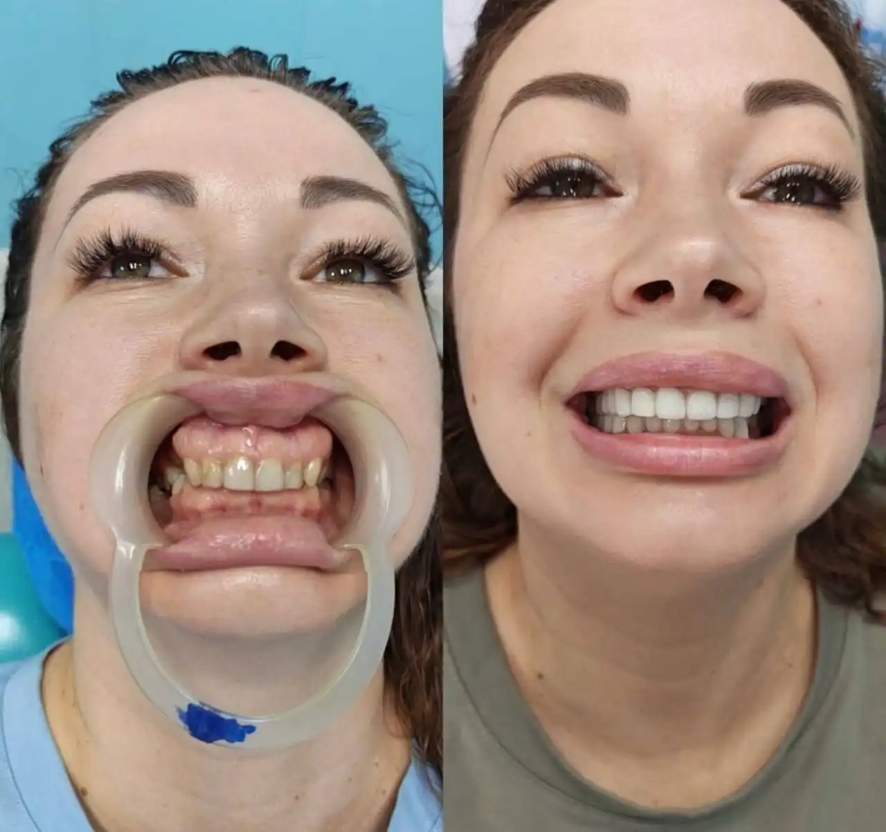 Скидка на металлокерамические коронки