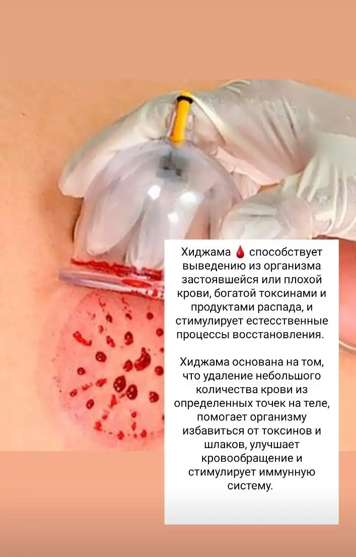 Услуги хиджамы и стоун-терапии