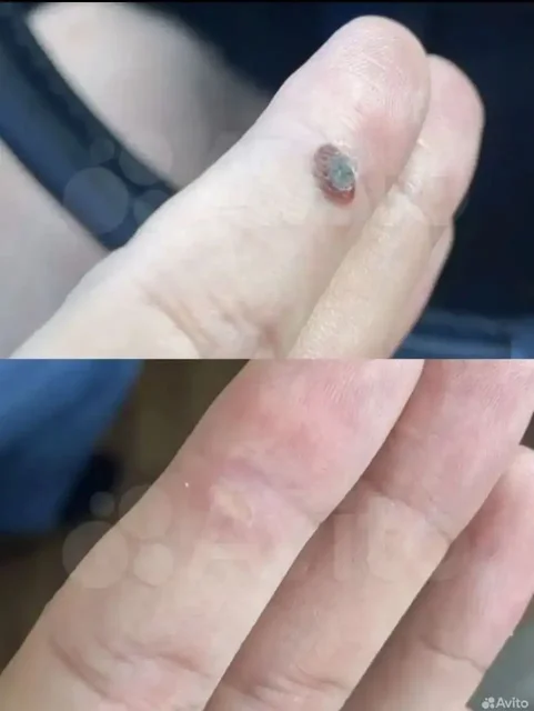 Натуральные кремы от грибка, бородавок, мозолей и папиллом - Кремы в Барнаул