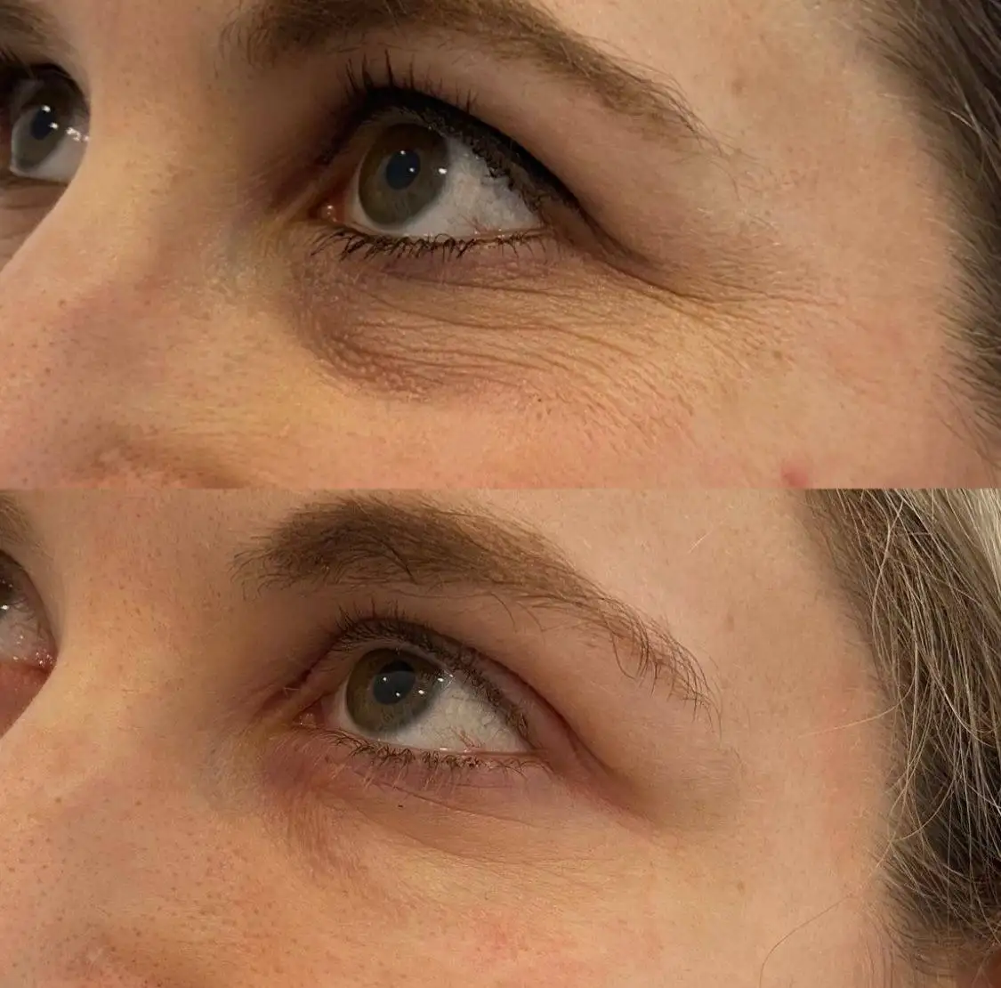 Косметологические услуги по омоложению лица - Косметология (Красота и здоровье) в Реутов