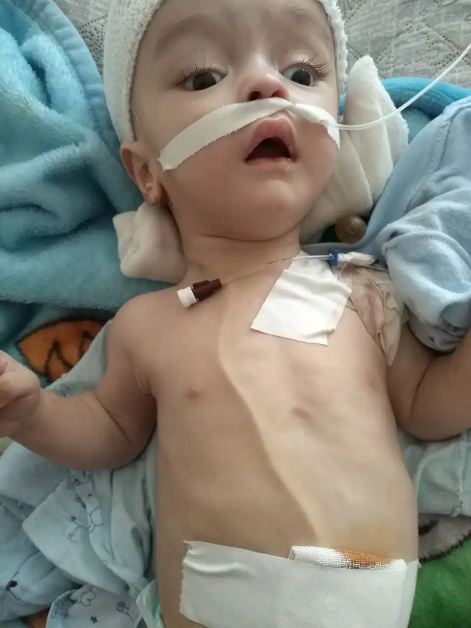 Просьба о помощи для лечения ребенка с диагнозом гидроцефалия