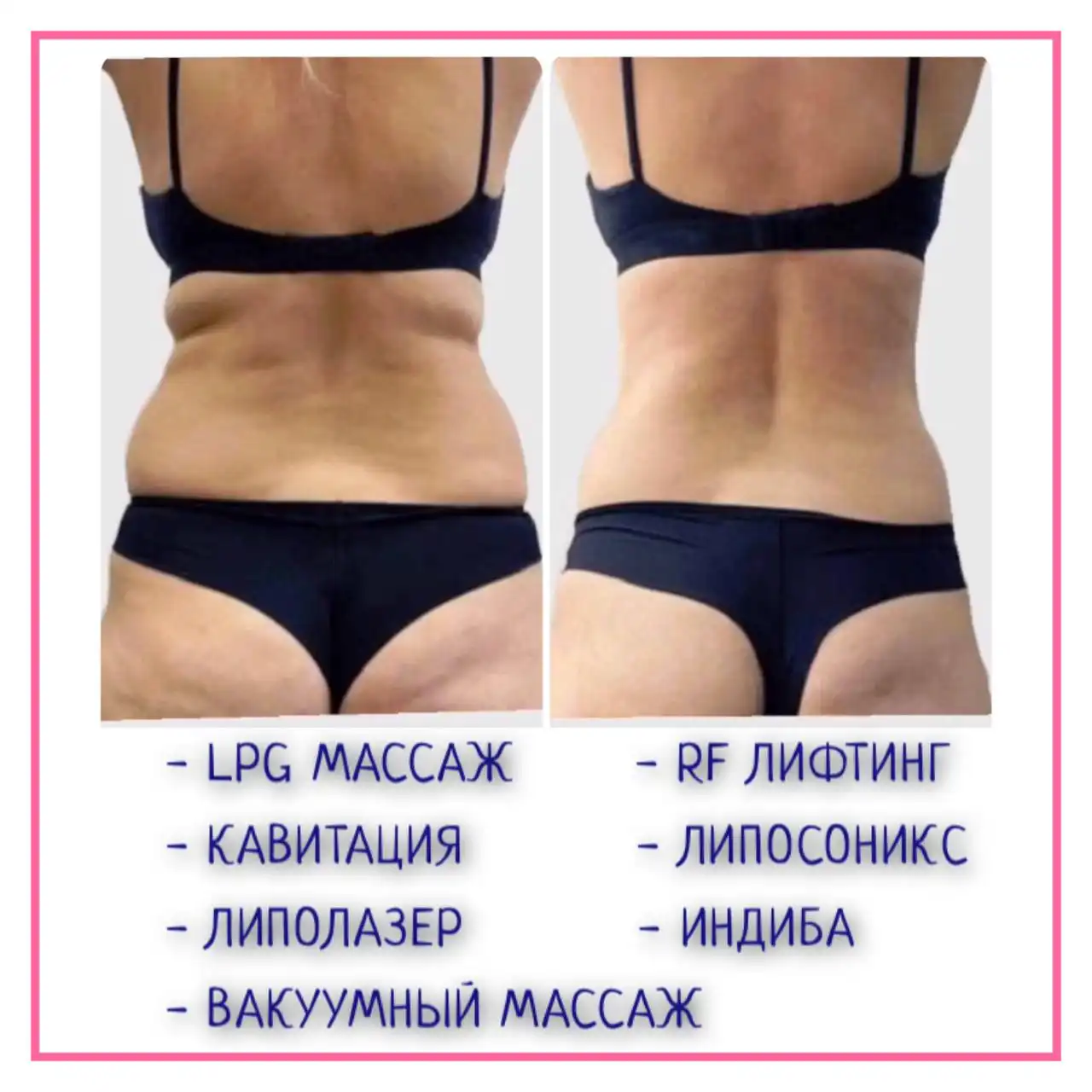 Коррекция фигуры