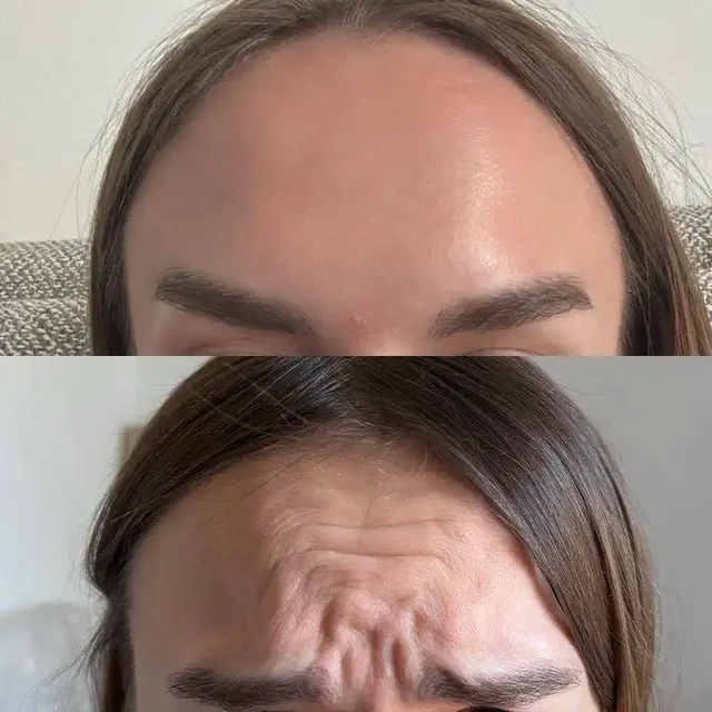 Ботулинотерапия от врача-косметолога - частное объявление в Красногорск