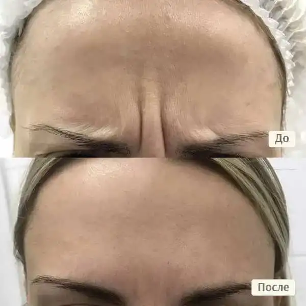 Ботулинотерапия от врача-косметолога - Косметология (Услуги) в Красногорск