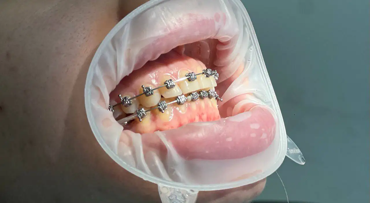 Профессиональная гигиена полости рта и лечение кариеса в Ульяновске - Услуги в Ульяновск